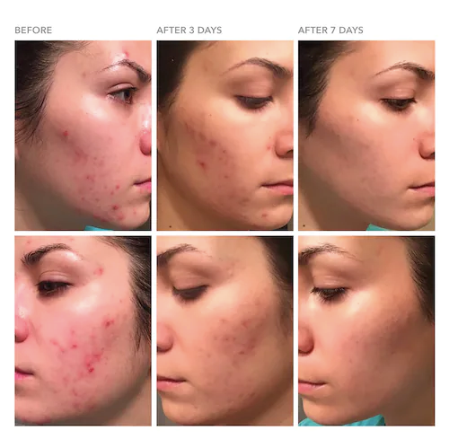 Load image into Gallery viewer, Dr. Dennis Gross Skincare DRx Blemish Solutions™ Acne Eliminating Gel
